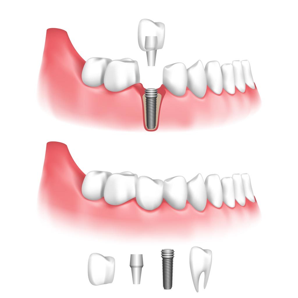 implant-dentaire-Lachat-dentiste-grenoble